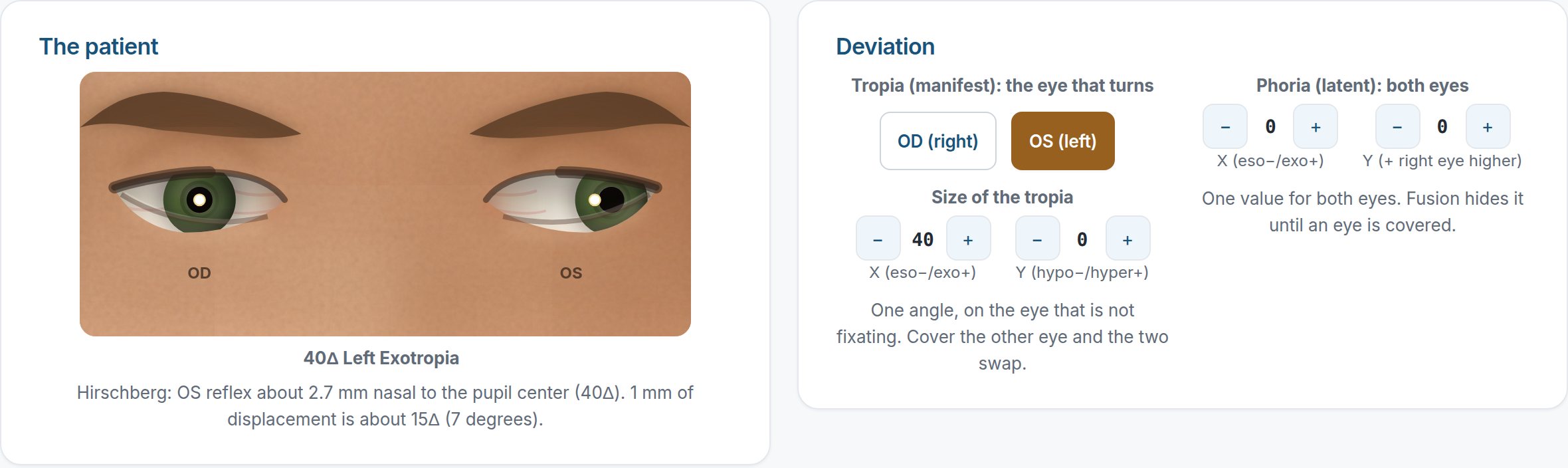 The strabismus simulator in Explore mode: a realistic patient with a 40 prism diopter left exotropia and the corneal light reflex showing, beside controls to set the tropia and phoria.